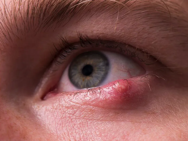 chalazion